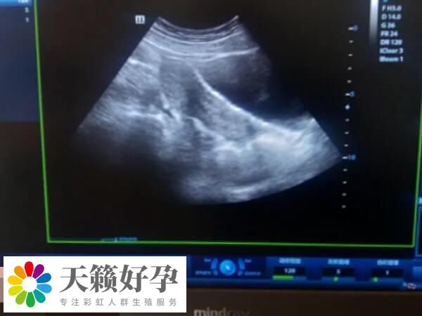 哪些情況下會取消鮮胚移植看這，孕酮升高的別盲目移